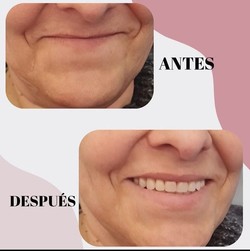 CONSULTORIO DENTAL, ODONTOLOGÍA INTEGRAL DRA CINTIA GOMEZ PROTESIS DE ACRÍLICO 