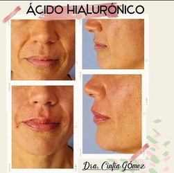 CONSULTORIO DENTAL, ODONTOLOGÍA INTEGRAL DRA CINTIA GOMEZ ACIDO HIALURONICO
