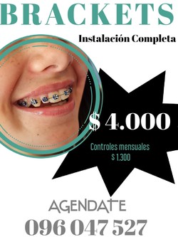 CONSULTORIO DENTAL, ODONTOLOGÍA INTEGRAL DRA CINTIA GOMEZ Beackets metálicos 