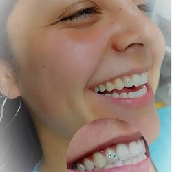 REDESCUBRÍ TU SONRISA Adornos dentales