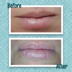 REDESCUBRÍ TU SONRISA Armonización orofacial por laserterapia de baja frecuencia