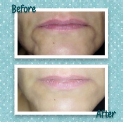 REDESCUBRÍ TU SONRISA Armonización orofacial por laserterapia de baja frecuencia