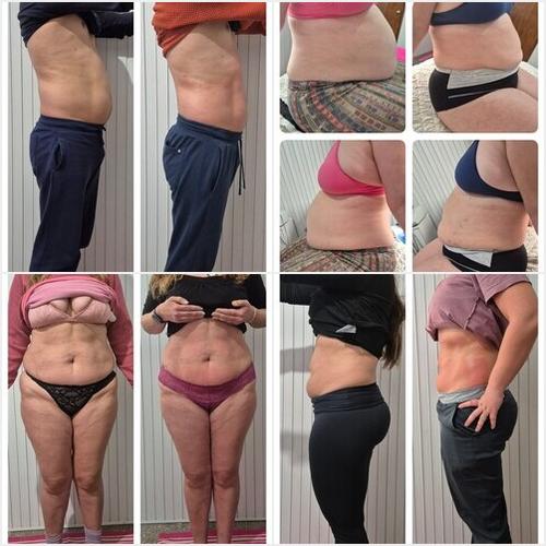 Tratamientos reductoras  BEAUTY UP