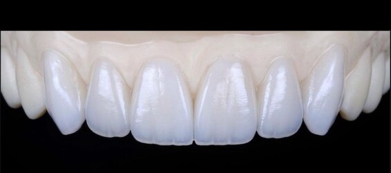 LABORATORIO DENTAL MPM Carillas E-Max