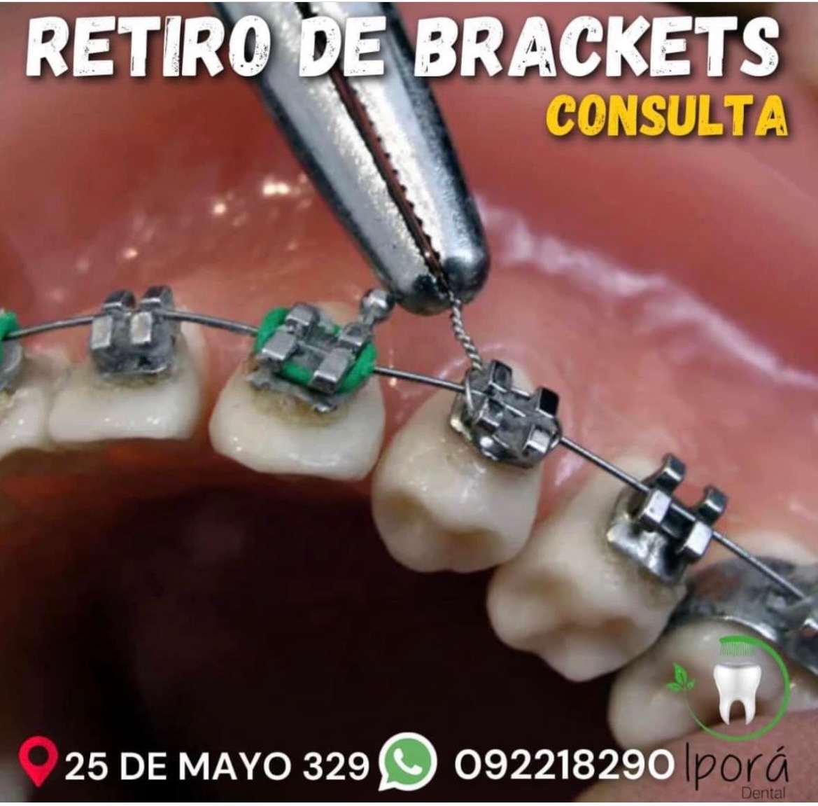 IPORÁ DENTAL Retiro de Brackets 