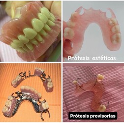 IPORÁ DENTAL Prótesis dentales
