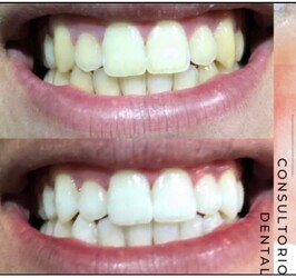 IPORÁ DENTAL Blanqueamiento dental