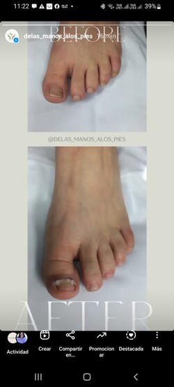 DE LAS MANOS A LOS PIES BIENESTAR INTEGRAL Tratamiento para uña con onicocriptosis