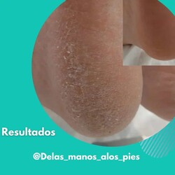 DE LAS MANOS A LOS PIES BIENESTAR INTEGRAL Sequedad en los talones