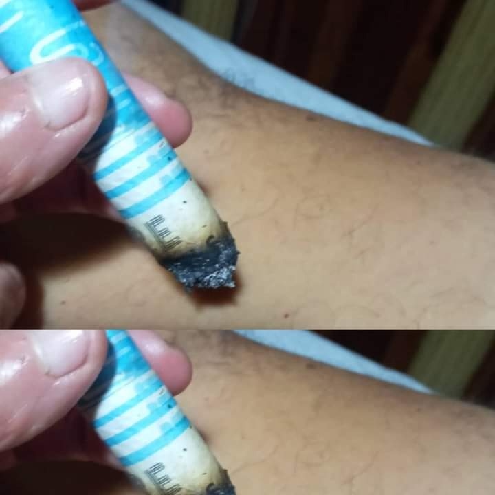 ESTETICA ARACELI GONZALEZ Moxibustion 
