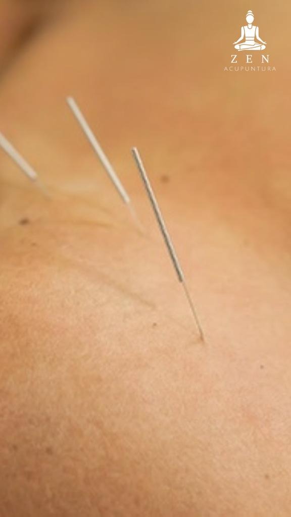 ZEN ACUPUNTURA  