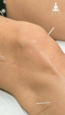 ZEN ACUPUNTURA 