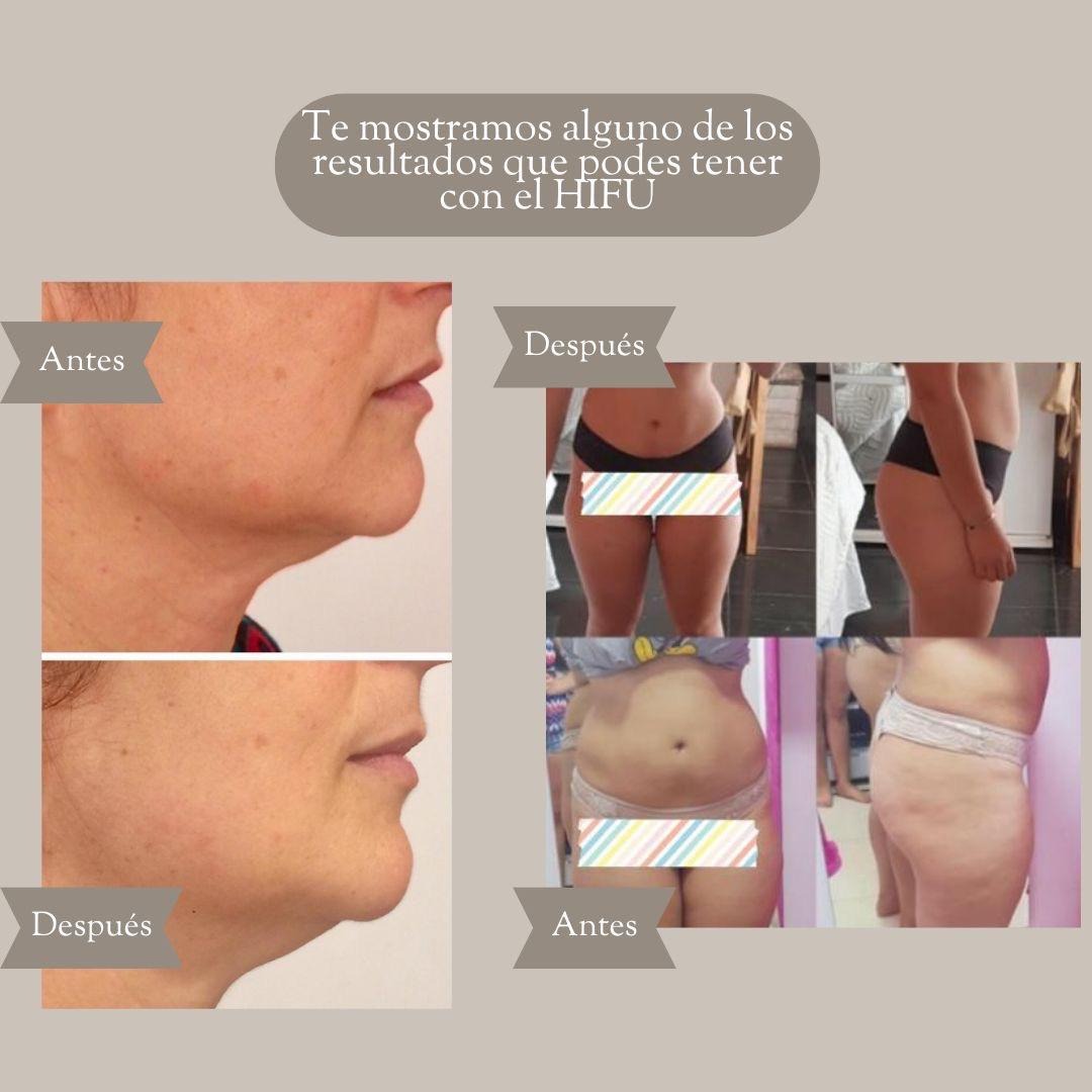 Verte Radiante Verte Radiante Antes y despues HIFU