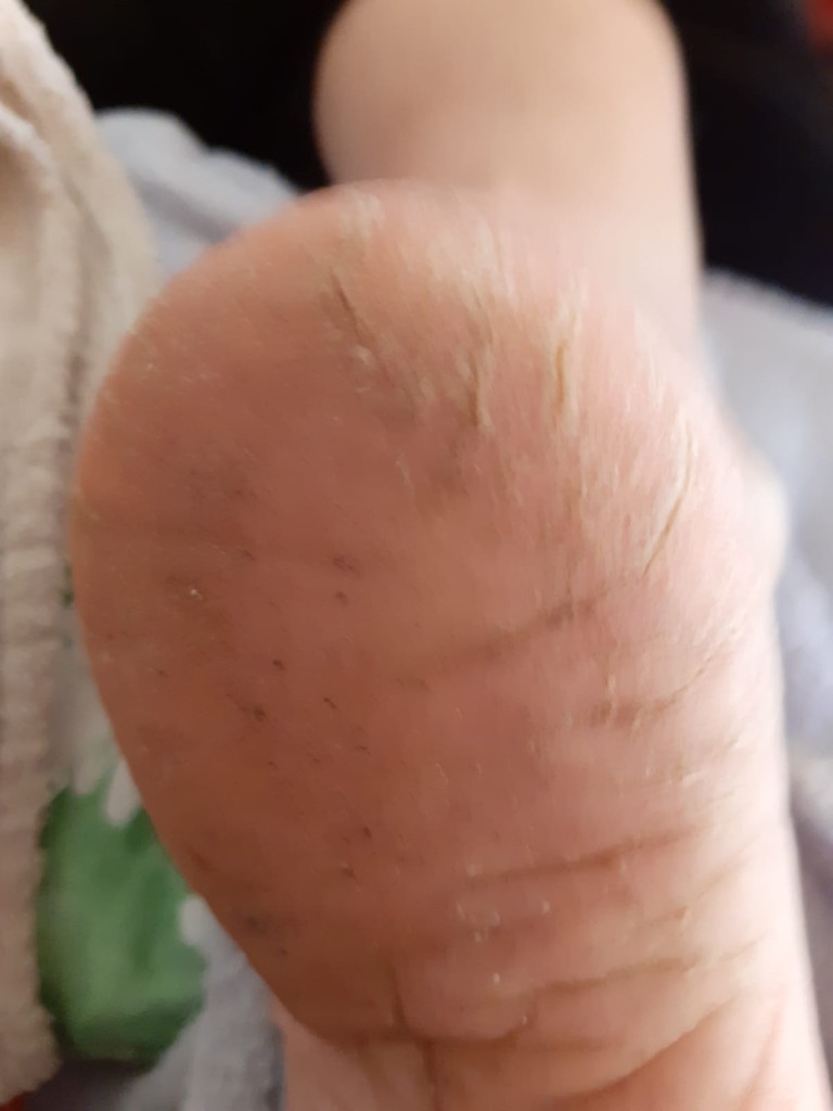 PODÓLOGA RAQUEL CORREA grietas de talones 