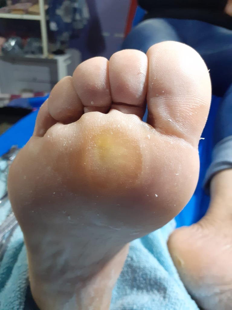 PODÓLOGA RAQUEL CORREA callosidades en planta 